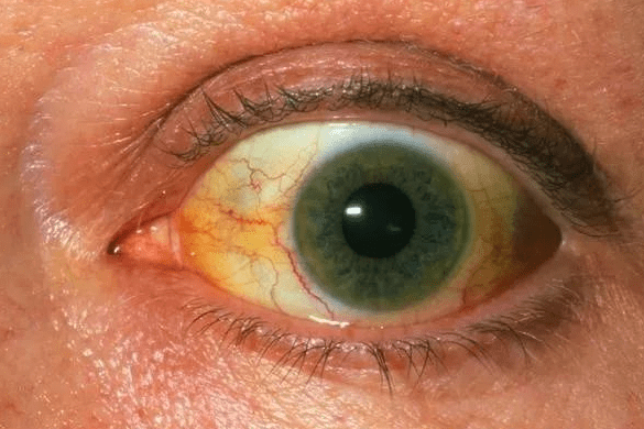 肝脏|口臭可能是肝不好？医生：肝不好有4个表现，对号入座看你占几个