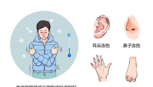 tips:冻伤是由于寒冷潮湿作用引起的人体局部或全身损伤.