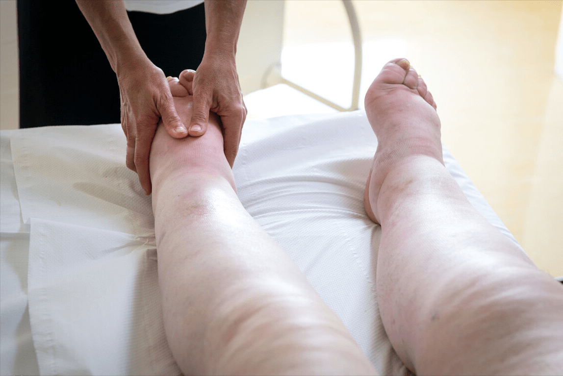 治疗|乙肝6大并发症,出现一个就需要及时就医,不要当儿戏