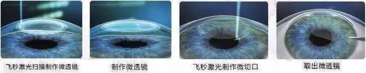 激光|普瑞眼科|“你真的了解吗” 想做近视手术先来看一看
