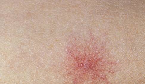 毒素|肝病“盯”上的人，脸上会有4个表现，希望你1个也不占