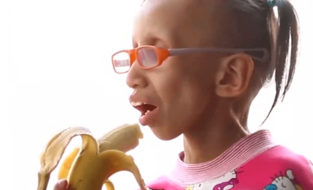 生命|14岁女孩拥有80岁“奶奶脸”，一年老10岁，父母为救女儿生下二胎