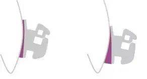 汕头|固定矫正也能看3D效果，数字化正畸导航系统了解一下