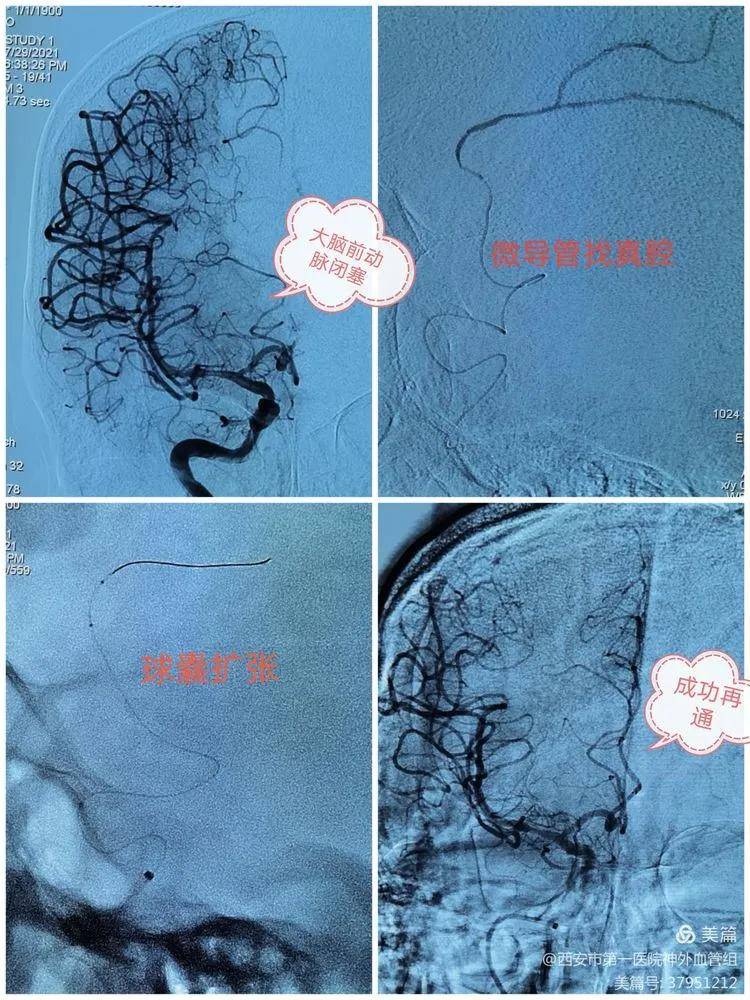 头颅|【医院动态】西安一院神外血管组介入病例系列15——7月“拆弹”“修路”记