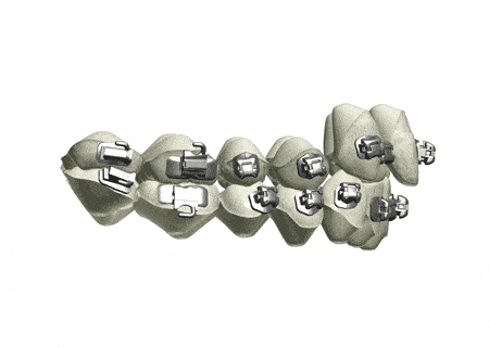 汕头|固定矫正也能看3D效果，数字化正畸导航系统了解一下