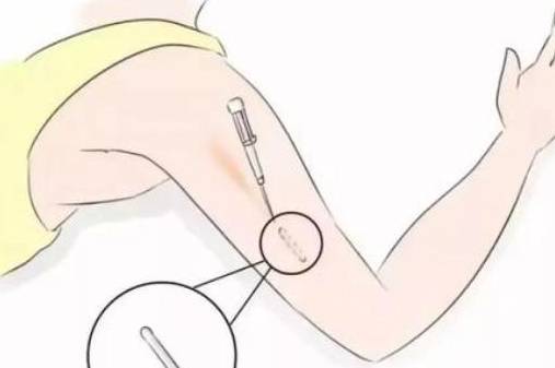 方法|被誉为“上环”进化版的新潮避孕，一次可管五年，还不影响要二胎