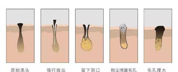 方法|速净黑头，收敛毛孔，还你光滑皮肤，这一个套盒就够了？！