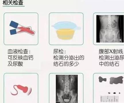 转氨酶|夏季肾结石高发，8个报警信号你收到了吗？