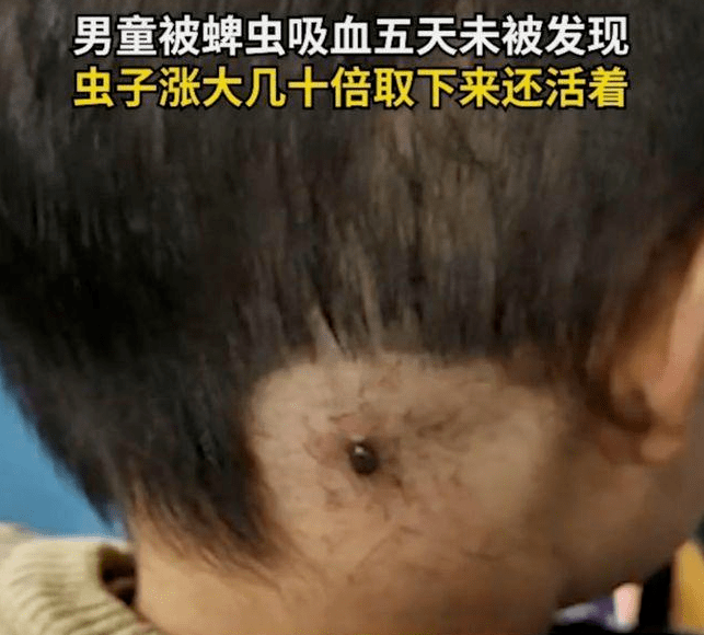 原创1个月3人丧命这种虫子专挑孩子下嘴