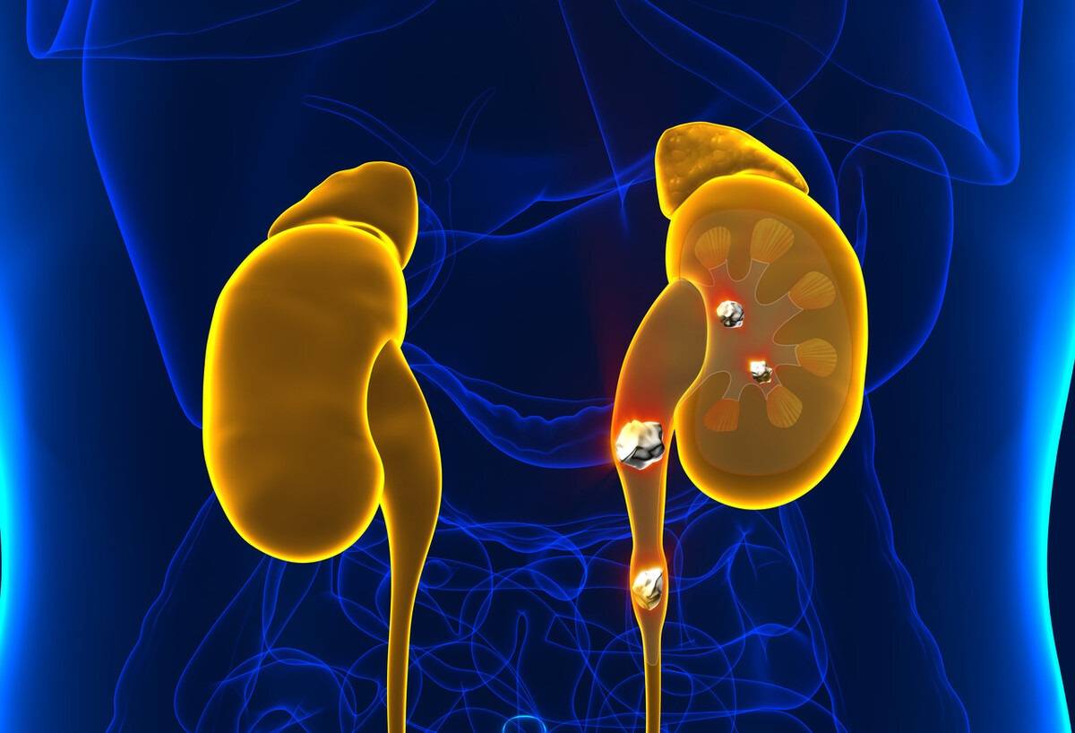 尿酸|钙盐结晶会形成肾结石，那么补钙安全吗，会发生肾结石吗？