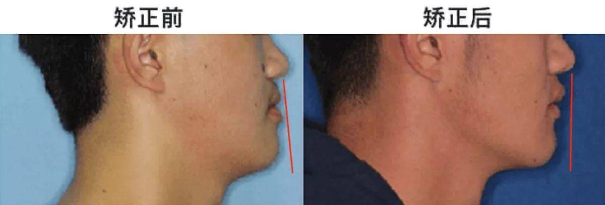 龅牙|广东省全民爱牙行动 地包天需要正畸正颌联合治疗