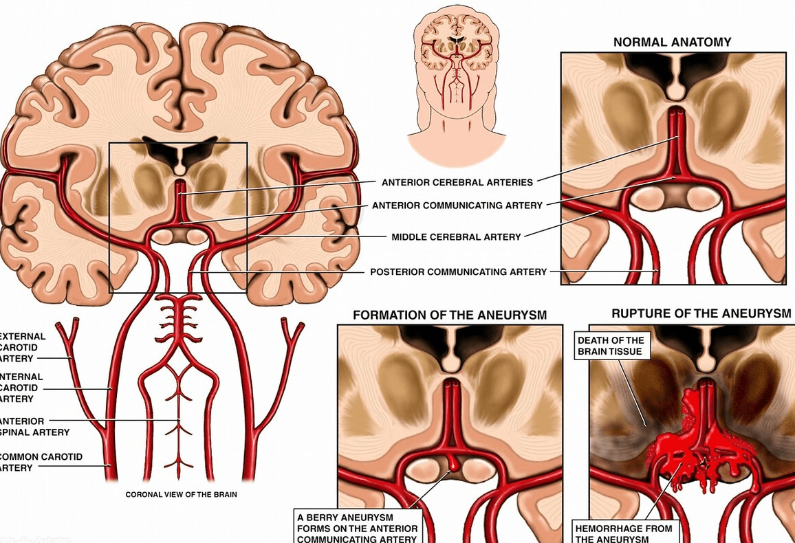 治疗|低颅压综合症，一般是什么症状？