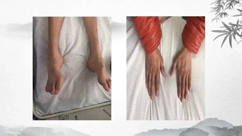 治疗|中西医结合治疗腓骨肌萎缩症1例,效果理想!