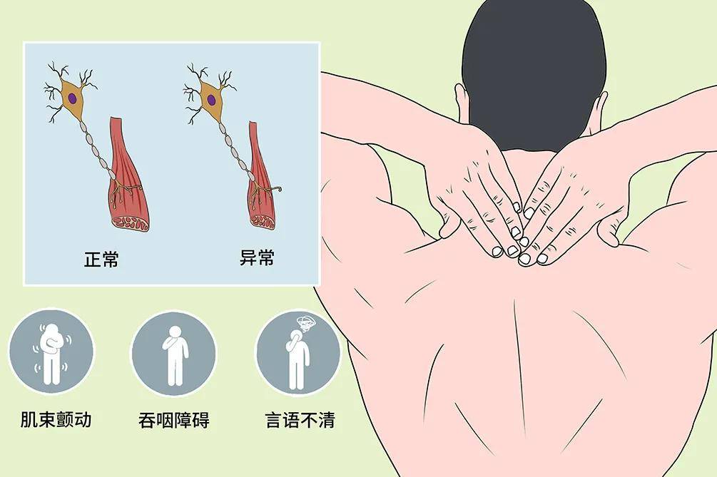 上肢|运动神经元病中医是怎么治疗的?