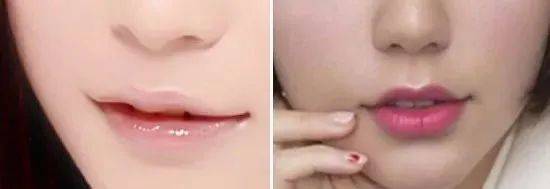 调整|嘟嘟唇、水光唇，告别盲目跟风，唇部可做医美大合集~