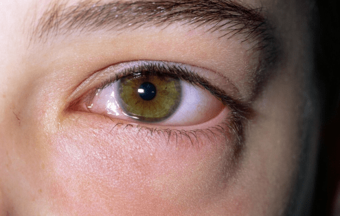 并发症|为何高血糖的人越来越多？这2物再不远离，并发症或找上门！