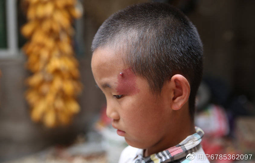 郑州市第二中医院:新生儿红胎记如何安全去除?