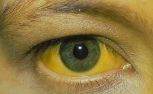 肝脏|肝脏变硬时，身体会有4个异常，一个没有，说明你的肝脏还算健康