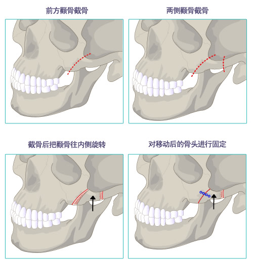 整形|邱立东讲解颌面整形中的常见问题（1）