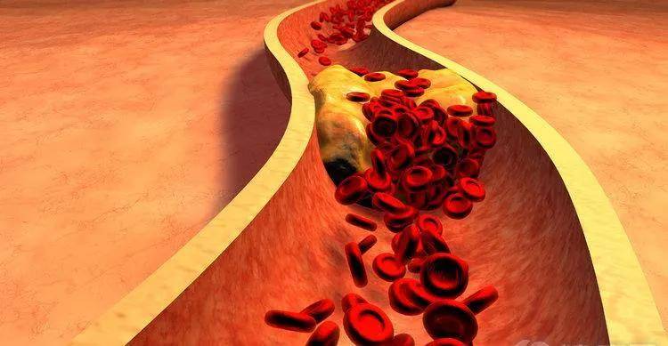 综合征|心血管病/代谢综合征患者速看 一种有效的疾病预防手段