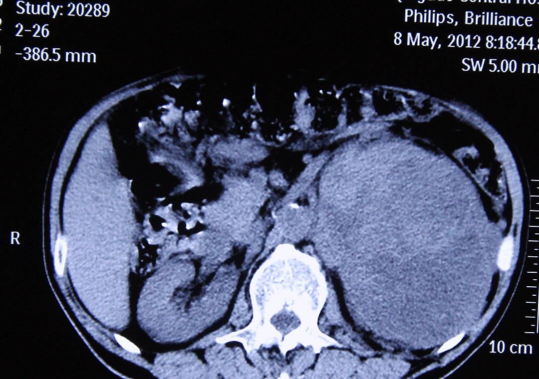 治疗|体检查出肾囊肿怎么办？别慌，3个治疗方法，让肾慢慢好起来