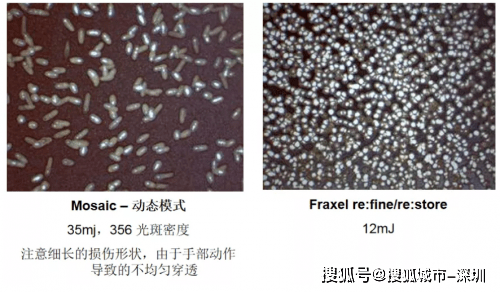 玛吉|热玛吉同门姐妹：飞梭镭射Fraxel美白、缩毛孔绝了！