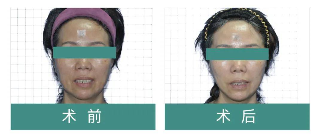 面部|法令纹太深怎么办？菲翎线提升效果好吗？