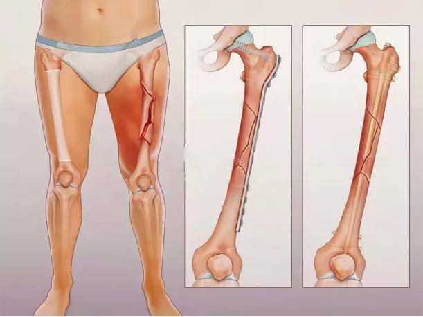 大腿根部骨折怎么办
