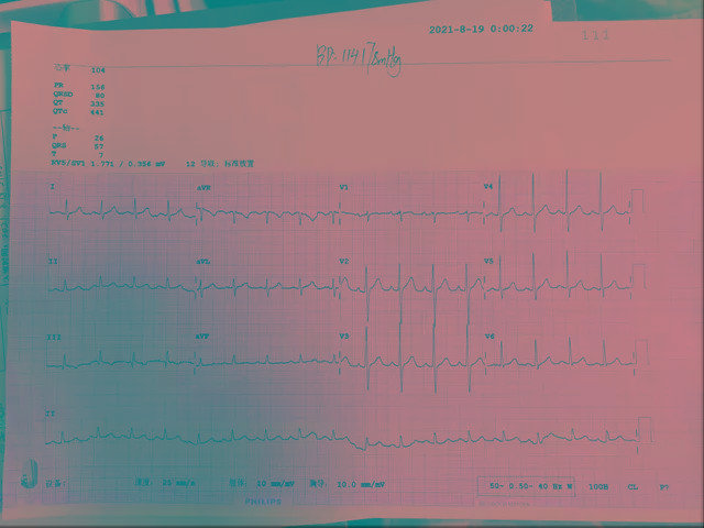 成功|山西省汾阳医院心内一科为一例持续性房颤患者成功实施房颤射频消融术