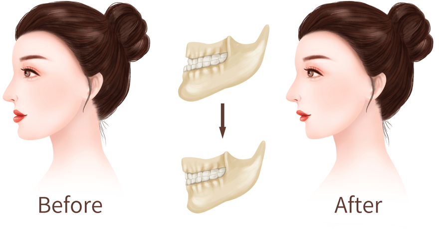 青少年|牙齿矫正知多少