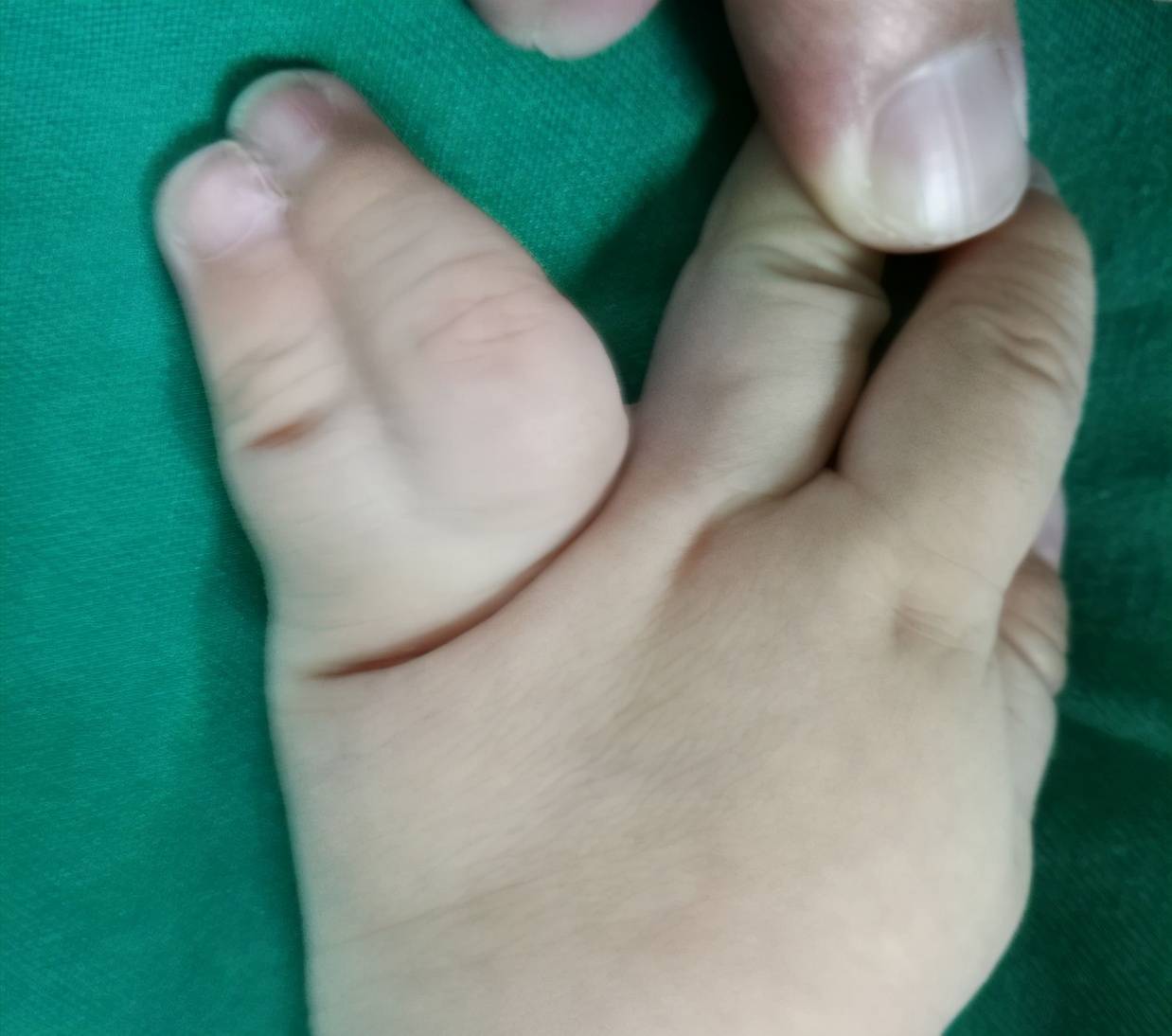 这是一个双手并指的孩子,两只手都是环指和小指并指,由于环指比小指长