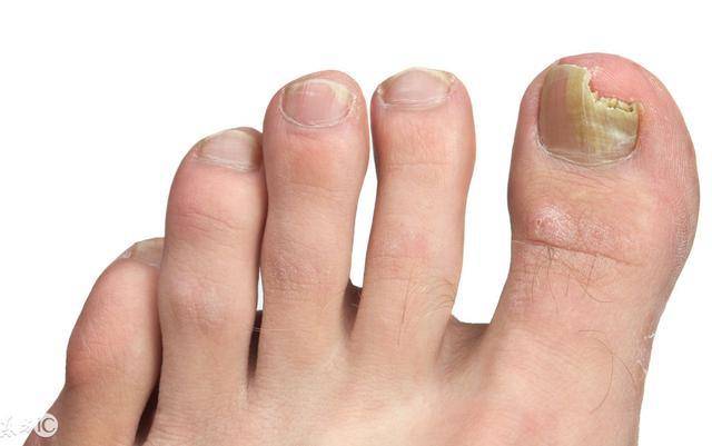 灰指甲怎样治疗最正确 974bfaeffde3467cb7c3d209194f3db0.jpeg