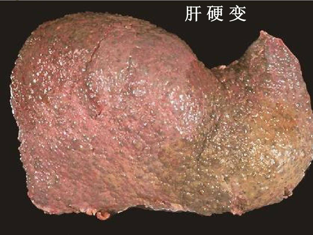 治疗|乙肝脸上会出现3种症状,中医用“土方子”,让你跟乙肝说拜拜