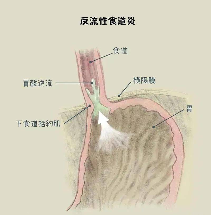 如何预防反流性食管炎