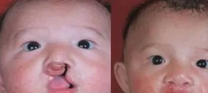 因为|孕妈生下兔唇儿，婆婆怪怀孕时吃了兔子肉，医生：兔子很委屈