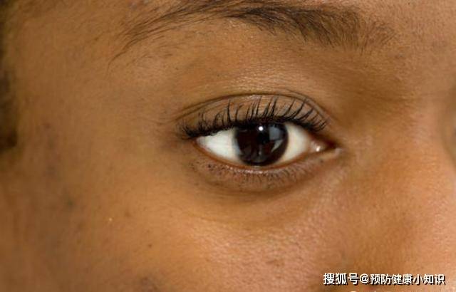 6,黑眼圈黑眼圈引起的情况有两种,一种是睡眠不好