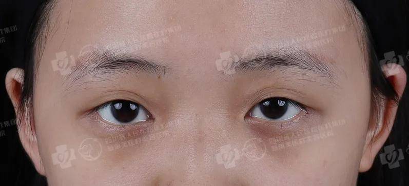 进行|“这些双眼皮贴我用不到了，你一半我姐一半”