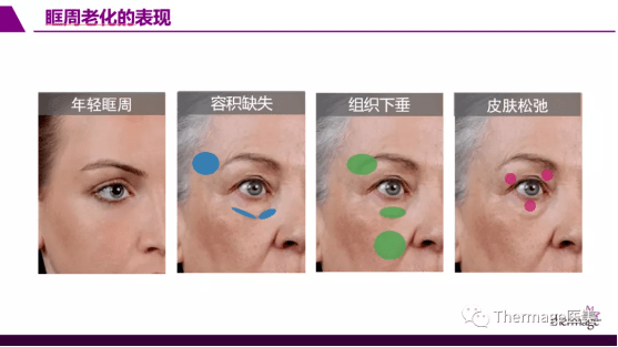 br|眶周老化丨热玛吉眼部专项抗衰第二期