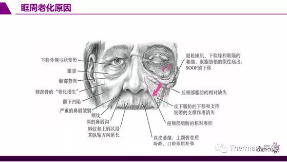 br|眶周老化丨热玛吉眼部专项抗衰第二期