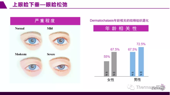 br|眶周老化丨热玛吉眼部专项抗衰第二期