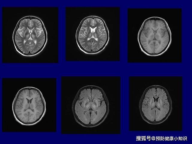 症状|肝豆状核变性是一种先天疾病,有家族史者,应进行基因检测