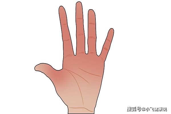 严重|肝脏不好,身体不会沉默,手部若有“突变”,或是肝病给的提示