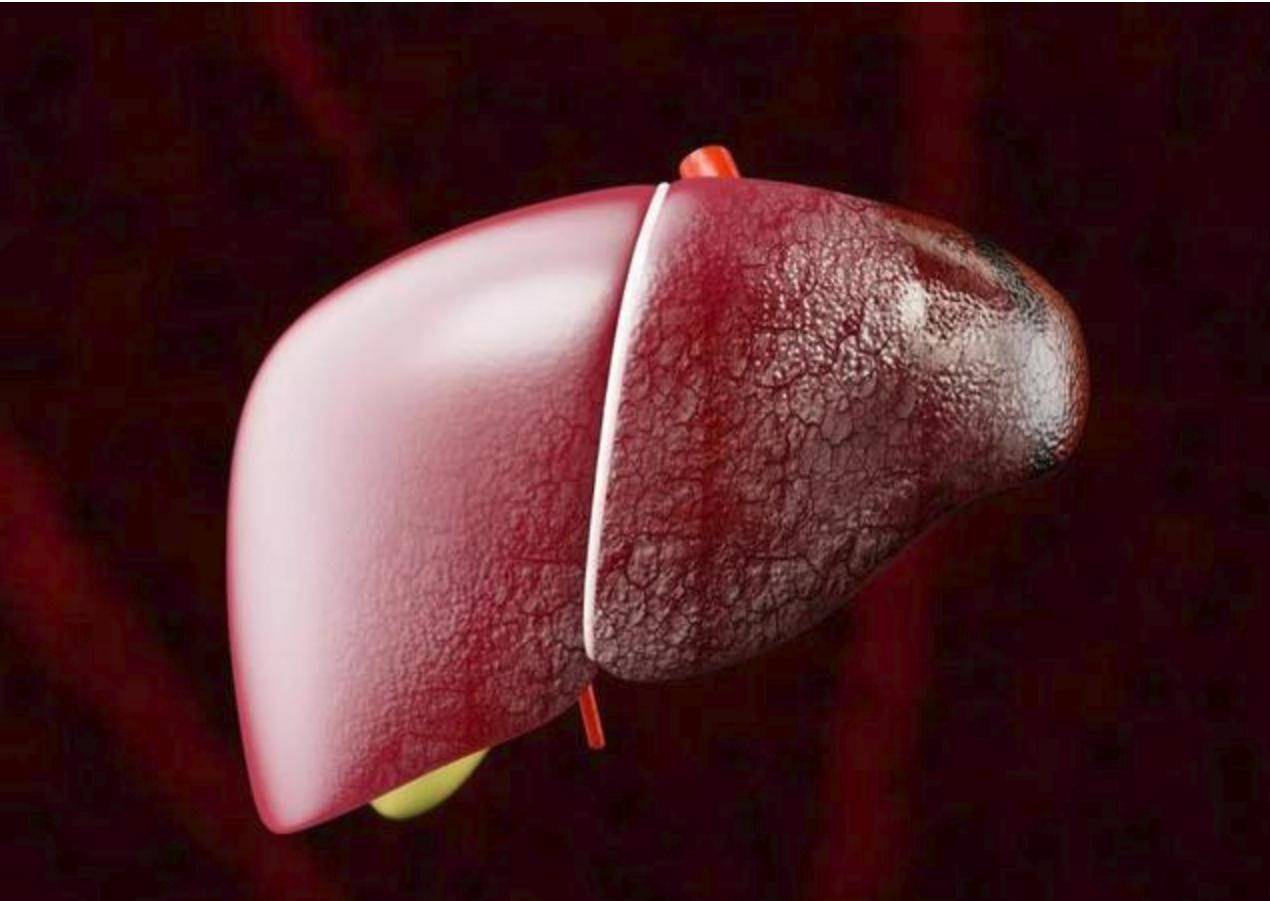治疗|治疗肝硬化有哪些方式？医生：4个治疗方案，把你拉出鬼门关