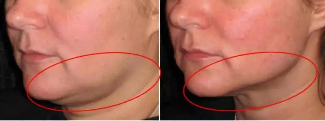 人群|黄金微雕、酷塑、美修斯、威塑 | 谁是下一个塑形之王？