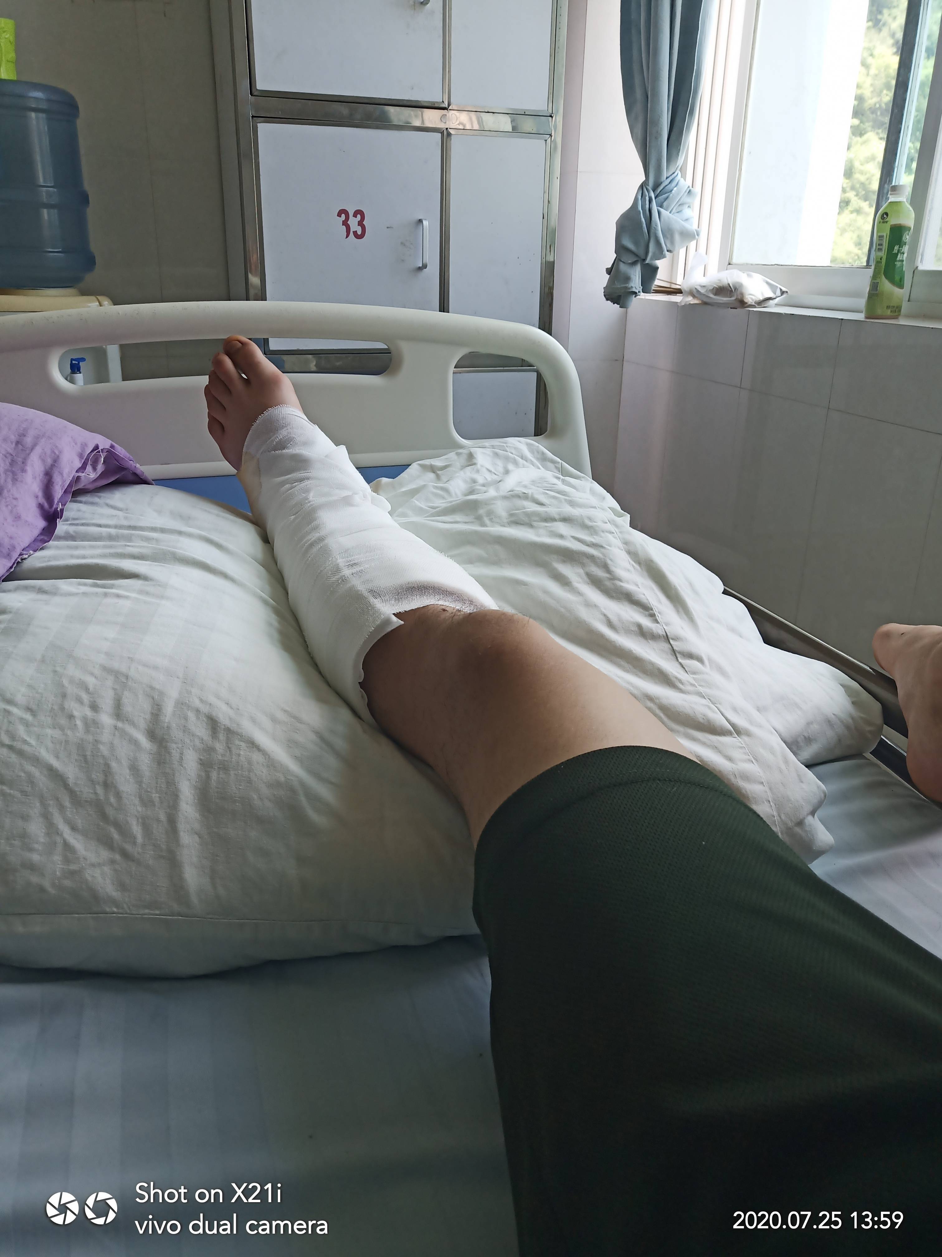 "去年2月份,他在街道上消杀毒菌中从高处垂直坠落,右足多处骨折和脱位