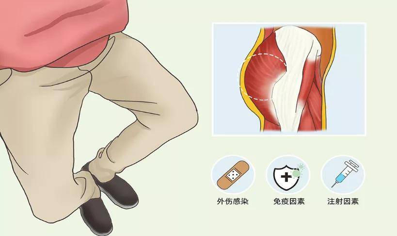 臀部|丨康复馆丨您有蹲不下去的时候吗？