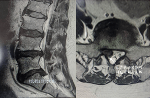 系列|PEID治疗巨大腰椎间盘突出症 ——脊柱微创手术系列