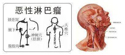 淋巴瘤對人體的影響