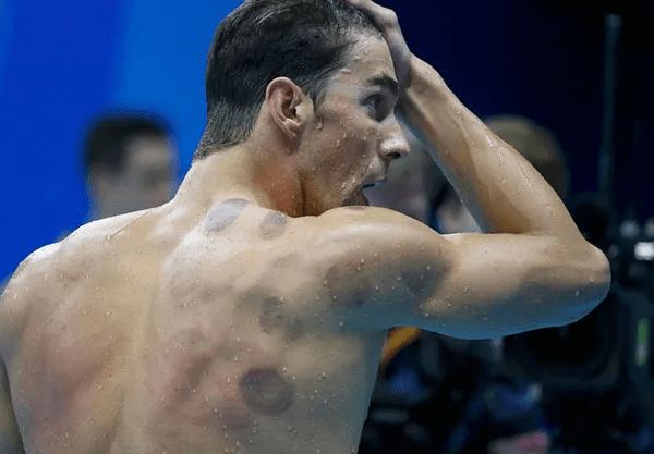 文化|这届老外，终于知道拔罐的秘密了？