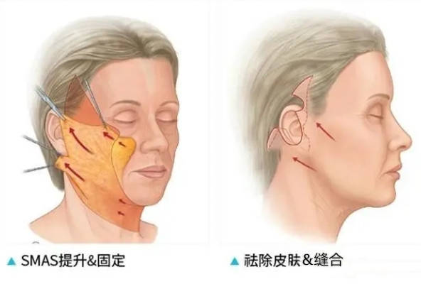 什么|过来人经验分享，给想做拉皮手术的人几句忠告